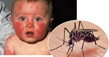 Virus Zika gây teo não đe dọa xâm nhập vào Việt Nam