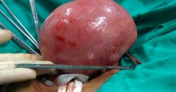 Cắt bỏ thành công khối u “khổng lồ” trong cơ thể người phụ nữ