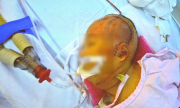 Cứu bé gái 20 ngày tuổi mắc bệnh lạ lần đầu gặp tại Việt Nam