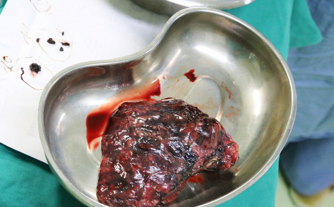 Khối u ở phổi sau khi được cắt bỏ