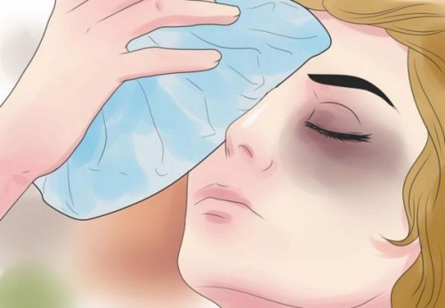Khi mắt bị sưng tím, nên dùng đá cục bọc bằng khăn sạch áp lên mắt trong vài phút