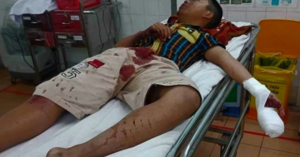 Gia Lai: Thiếu niên bị thương khi pháo tự chế phát nổ trên tay