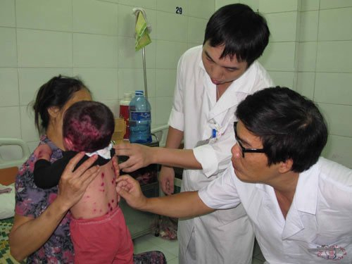 Nhiều trẻ vẫn mắc thủy đậu d&ugrave; đ&atilde; ch&iacute;ch ngừa vắc-xin 1 lần. Ảnh: Vietnamnet