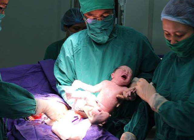Trường hợp song thai IVF đầu ti&ecirc;n ra đời tại Bệnh viện Sản Nhi Quảng Ninh v&agrave; đặc biệt đ&acirc;y l&agrave; trường hợp song thai c&ugrave;ng trứng, 1 b&aacute;nh rau 1 buồng ối (ảnh Bệnh viện cung cấp)