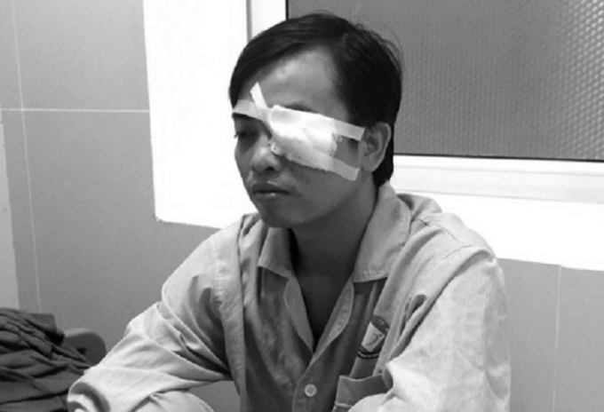 B&aacute;c sĩ Trần Văn Sơn phải điều trị chấn thương nặng v&ugrave;ng mắt do bị h&agrave;nh hung.