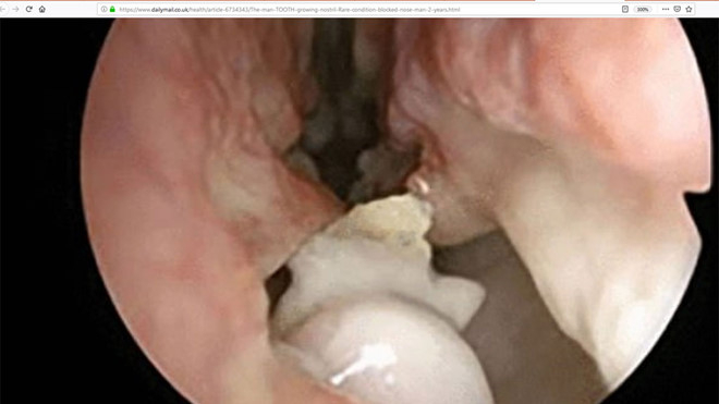 Chiếc răng được ph&aacute;t hiện trong hốc mũi của một người đ&agrave;n &ocirc;ng 59 tuổi  ẢNH CHỤP M&Agrave;N H&Igrave;NH DAILY MAIL ​