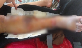 Bộ Y tế yêu cầu làm rõ thông tin nữ sinh mất chân vì bệnh viện tắc trách