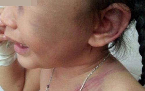 Em bé 3 tuổi bị cha dượng đánh đập dã man