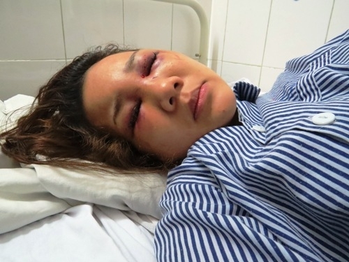 Chị Thảo đang được điều trị tại&nbsp;Bệnh viện hữu nghị Việt &ndash; Tiệp trong t&igrave;nh trạng đa chấn thương (Ảnh b&aacute;o giao th&ocirc;ng).