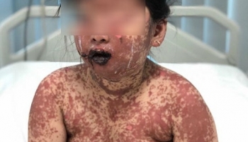 Dị ứng thuốc, bé 7 tuổi bị bỏng toàn thân
