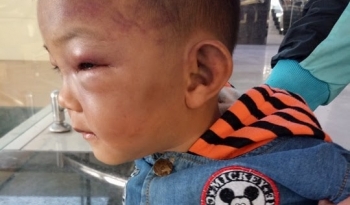 Bé trai 2 tuổi nhập viện với nhiều vết thương nghi do bị cha dượng đánh đập