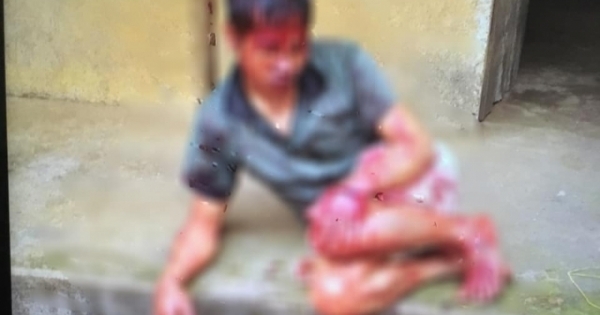 Bắc Giang: Người đàn ông tâm thần bị hàng xóm chém 7 nhát vào đầu