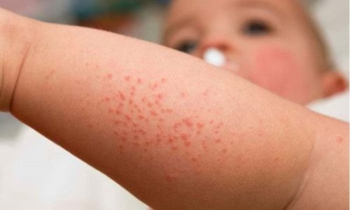 Cha mẹ “tẩy chay” vắc xin khiến con mắc bệnh nguy hiểm