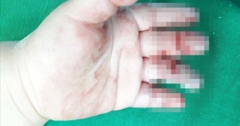 Cháu bé 16 tháng tuổi dập nát ngón tay do bị cuốn vào máy xay cá