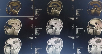 Phẫu thuật thành công ổ sán làm tổ trong não người đàn ông