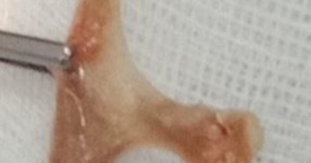 Nội soi gắp mảnh xương vịt 3 cm sắc nhọn cắm vào thực quản nam bệnh nhân