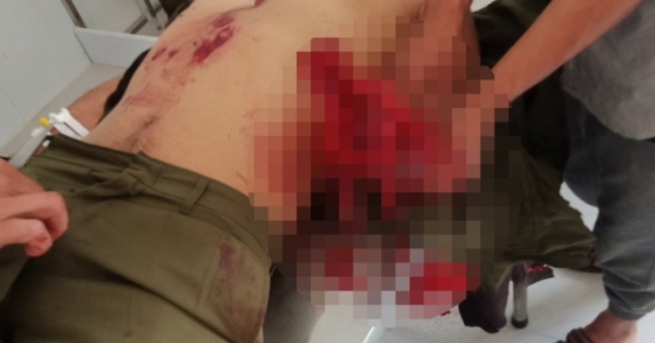 Lâm Đồng: Mang mìn tự chế đi đánh cá, 7 người bị thương nặng