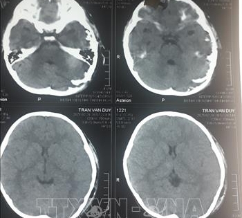 Phẫu thuật thành công cho bé 4 tuổi bị chó cắn hở sọ não