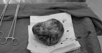 Ca “mổ kép” tách khối u buồng trứng 20 cm và em bé thành công