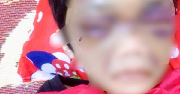 Hải Dương: Điều tra vụ bé gái 6 tuổi bị mẹ đẻ bạo hành đến mức phải nhập viện
