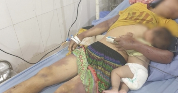Sơn La: Điều tra vụ việc chồng dùng củi đánh vợ nhập viện cấp cứu trong tình trạng đa chấn thương