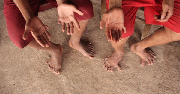 Kỳ lạ gia đình có 14 ngón chân, 12 ngón tay