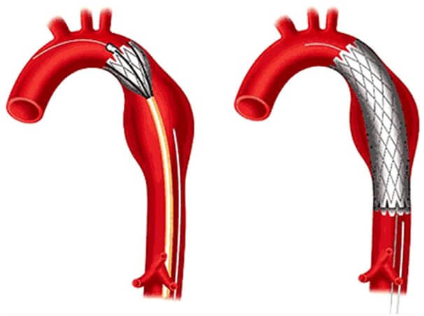 H&igrave;nh ảnh m&ocirc; phỏng stent đặt trong động mạch ph&igrave;nh, nhằm giảm &aacute;p lực cho động mạch. Ảnh IT.