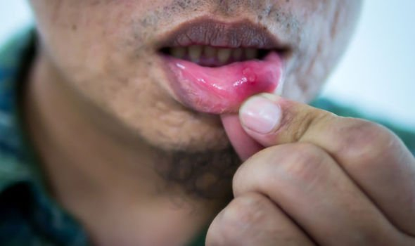 Lo&eacute;t miệng l&agrave; triệu chứng thiếu B12&nbsp;(Ảnh: Getty Images)