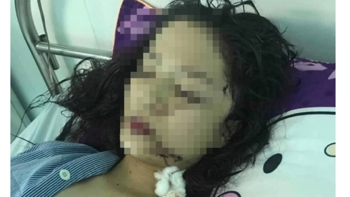 Thiếu nữ ở Bắc Ninh bị rạch mặt phải khâu 60 mũi