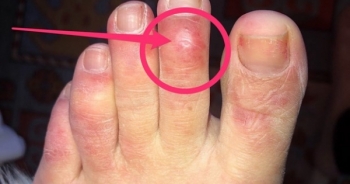 Ngón chân bị sưng có thể là triệu chứng mới của COVID-19