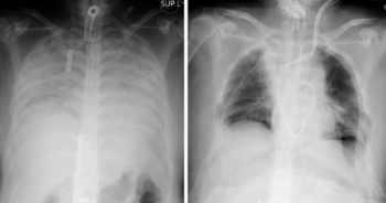 Trường hợp hy hữu nhiễm Covid-19 được ghép phổi từ người hiến tặng còn sống