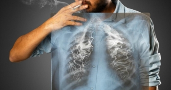 Năm 2020, hơn 23.000 ca tử vong do ung thư phổi