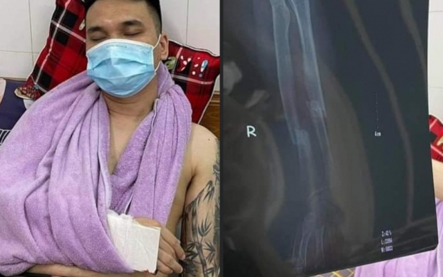 Ca sĩ Khắc Việt bị gãy tay phải nhập viện