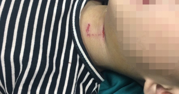 Nghệ An: Bé 3 tuổi bị chó hàng xóm tấn công, cắn rách phần cổ, thủng khí quản