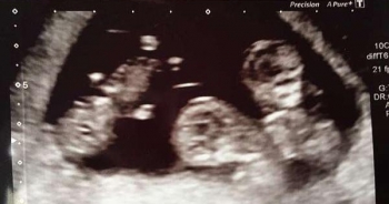 Cô gái sinh 2 con cách nhau 4 ngày, vẫn còn 2 thai nhi trong bụng