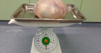 Phẫu thuật bóc tách khối u nặng gần 6kg ra khỏi cơ thể người phụ nữ