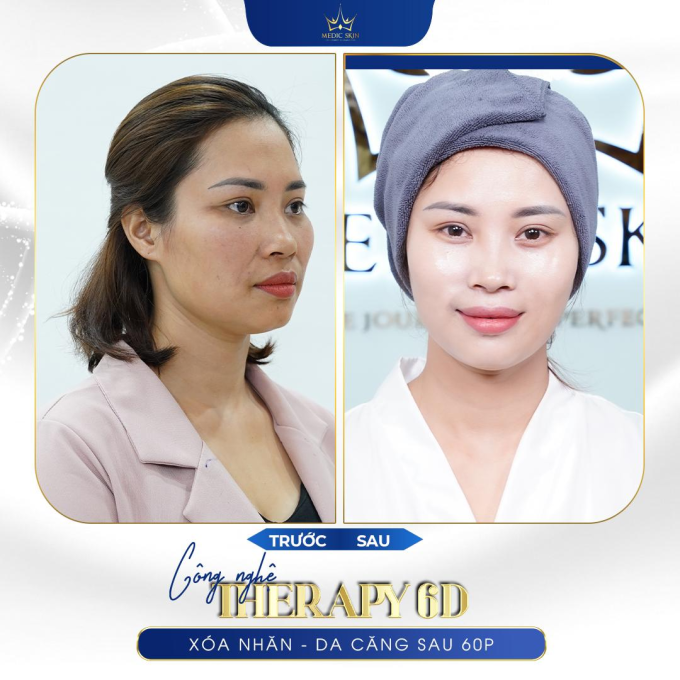 Hình trước và sau khi trẻ hóa của khách hàng thực tế tại Medic Skin.