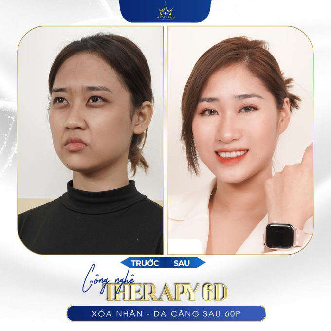 Hình trước và sau khi trẻ hóa của khách hàng thực tế tại Medic Skin.