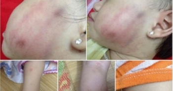 Nghi án bé 16 tháng tuổi bị cô giáo đánh bầm tím: Đây không phải lần đầu!