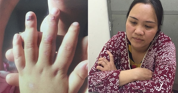 Lạng Sơn: Mẹ hờ bạo hành con của chồng, khắp cơ thể chi chít vết thương