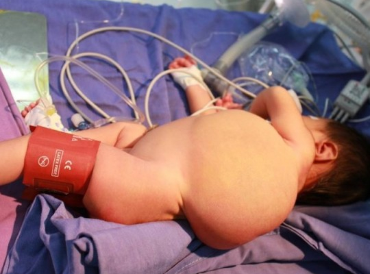 Phẫu thuật khối u bạch huyết khổng lồ cho bé trai 20 tháng tuổi