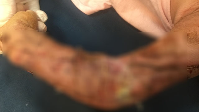 Cánh tay trái của bé Bảo sau khi được các bác sĩ tiến hành vá da. Ảnh: BVCC
