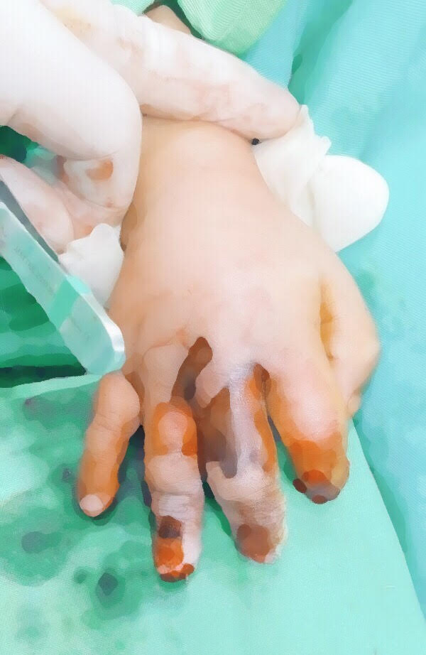 Bàn tay phải của bệnh nhi sau phẫu thuật. Ảnh: BVCC