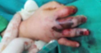 Kẹt tay vào máy ép mía, bé trai 4 tuổi bị dập nát đốt tay