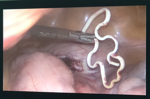 Cận cảnh hình ảnh vòng tránh thai được kíp bác sĩ tiến hành lấy trong ổ bụng bệnh nhân. Ảnh: BVCC.
