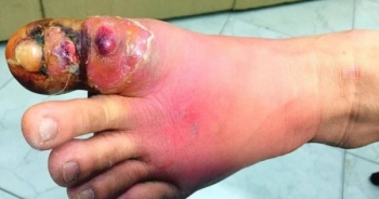 Cắt khóe móng chân tại nhà, một phụ nữ bị hoại tử nhiễm trùng nặng bàn chân