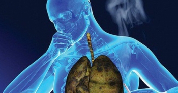 Dấu hiệu nhận biết sớm ung thư phổi
