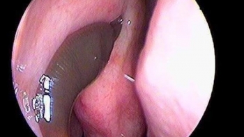 Clip - Rợn người cảnh quá trình gắp con đỉa dài 5 cm đang hút máu trong mũi nữ bệnh nhân