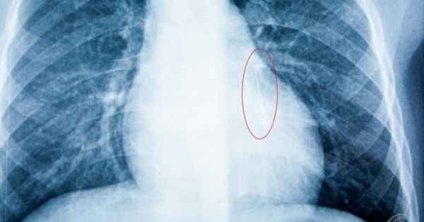 Nghệ An: Bàng hoàng phát hiện kim nhọn dài 2,5 cm trong phổi bệnh nhi 5 tuổi