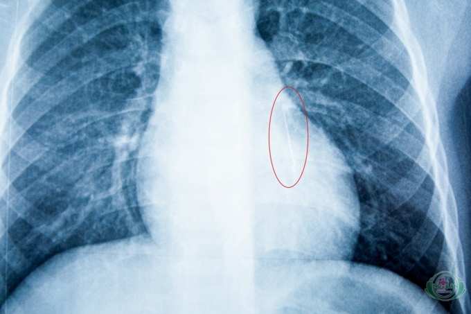 H&igrave;nh ảnh chụp XQuang cho thấy chiếc kim d&agrave;i 2,5 cm nằm trong phổi của bệnh nhi.